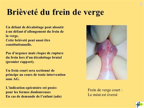 rupture du frein du prepuce|RUPTURE DU FREIN DE LA VERGE